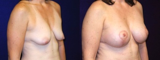 Right 3/4 View - Breast Augmentation with Lift After Pregnancy