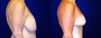 Right Profile View - Breast Reduction After Weight Loss