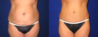 Frontal View - Tummy Tuck After Pregnancy