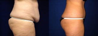 Right Profile View - Tummy Tuck and Liposuction