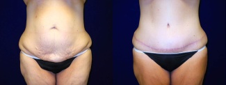 Frontal View - Tummy Tuck