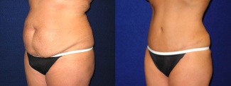 Left 3/4 View - Tummy Tuck After Pregnancy