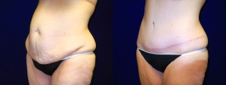 Left 3/4 View - Tummy Tuck