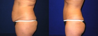 Left Profile View - Tummy Tuck After Pregnancy