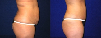 Right Profile View - Tummy Tuck After Pregnancy