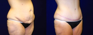 Right 3/4 View - Tummy Tuck