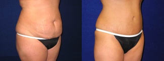 Right 3/4 View - Tummy Tuck After Pregnancy