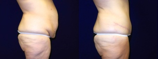 Right Profile View - Tummy Tuck