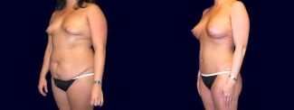Left 3/4 View - Breast Augmentation with Periareolar Lift & Tummy Tuck