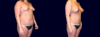 Right 3/4 View - Breast Augmentation with Periareolar Lift & Tummy Tuck