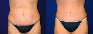 Frontal View - Tummy Tuck