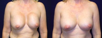 Frontal View - Breast Implant Revision - Silicone Implants