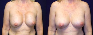 Frontal View - Breast Implant Revision - Silicone Implants