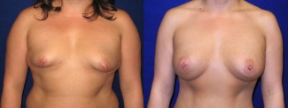 Frontal View - Breast Augmentation with Silicone Implants and Periareolar Mastopexy