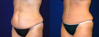 Left 3/4 View - Tummy Tuck