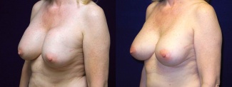 Left 3/4 View - Breast Implant Revision - Silicone Implants