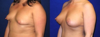 Left 3/4 View - Breast Augmentation with Silicone Implants and Periareolar Mastopexy