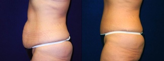 Left Profile View - Tummy Tuck