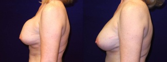 Left Profile View - Breast Implant Revision - Silicone Implants
