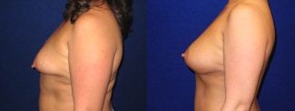 Left Profile View - Breast Augmentation with Silicone Implants and Periareolar Mastopexy