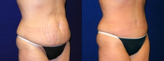 Right 3/4 View - Tummy Tuck