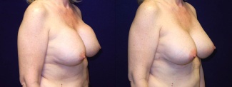 Right Profile View - Breast Implant Revision - Silicone Implants