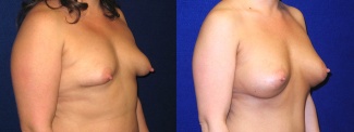 Right 3/4 View - Breast Augmentation with Silicone Implants and Periareolar Mastopexy
