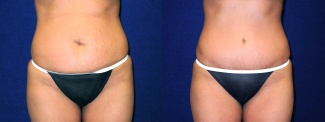 Frontal View - Tummy Tuck After Pregnancy