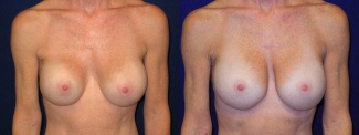 Frontal View - Breast Implant Revision - Silicone Implants