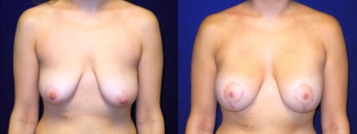 Frontal View - Breast Augmentation with Lift - Silicone Implants