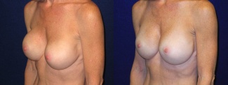 Left 3/4 View - Breast Implant Revision - Silicone Implants