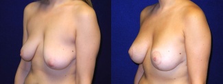 Left 3/4 View - Breast Augmentation with Lift - Silicone Implants