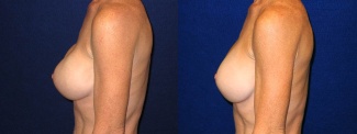 Left Profile View - Breast Implant Revision - Silicone Implants