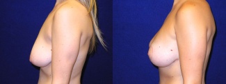 Left Profile View - Breast Augmentation with Lift - Silicone Implants