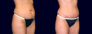 Right 3/4 View - Tummy Tuck After Pregnancy