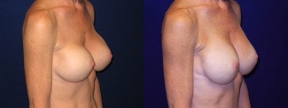 Right 3/4 View - Breast Implant Revision - Silicone Implants