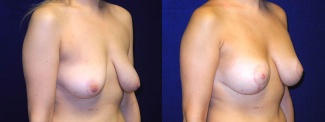 Right 3/4 View - Breast Augmentation with Lift - Silicone Implants