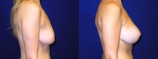 Right Profile View - Breast Augmentation with Lift - Silicone Implants