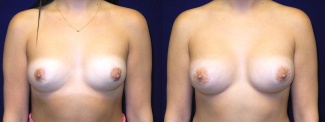 Frontal View - Breast Implant Revision - Silicone Implants