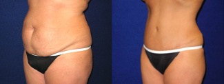 Left 3/4 View - Tummy Tuck After Pregnancy