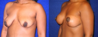 Left 3/4 View - Breast Augmentation with Lift - Silicone Implants