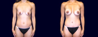 Frontal View - Breast Augmentation with Lift and Tummy Tuck After Pregnancy
