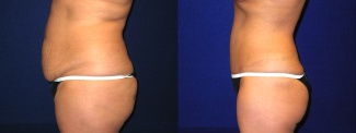 Left Profile View - Tummy Tuck After Pregnancy