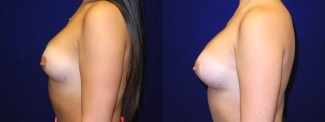 Left Profile View - Breast Implant Revision - Silicone Implants