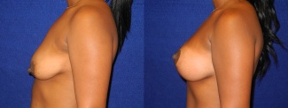 Left Profile View - Breast Augmentation with Lift - Silicone Implants