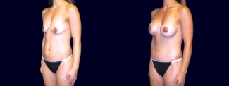 Left 3/4 View - Breast Augmentation with Lift and Tummy Tuck After Pregnancy