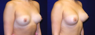 Right 3/4 View - Breast Implant Revision - Silicone Implants