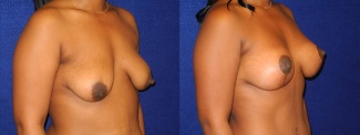 Right 3/4 View - Breast Augmentation with Lift - Silicone Implants