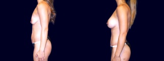 Left 3/4 View - Breast Augmentation with Lift and Tummy Tuck After Pregnancy