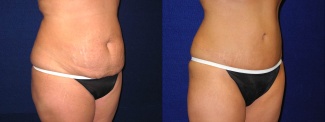 Right 3/4 View - Tummy Tuck After Pregnancy